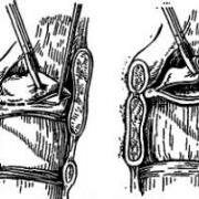 лечение удаление полипа гортани лечение удаление полипа гортани